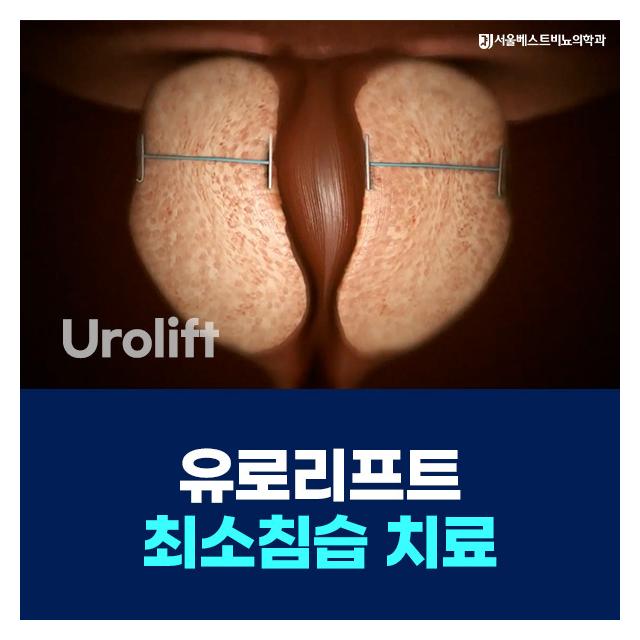 유로리프트 최소침습 치료 기능 보존에 중점 안전한 치료법